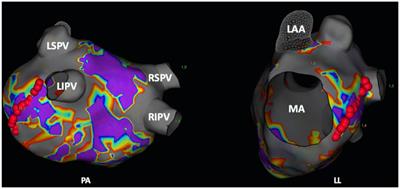 Temperature-controlled ablation of the mitral isthmus line using the novel DiamondTemp ablation system